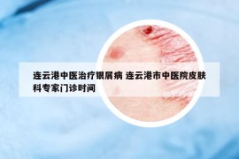 連云港中醫(yī)治療銀屑病 連云港市中醫(yī)院皮膚科專家門診時間