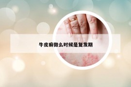 牛皮癬做么時(shí)候是復(fù)發(fā)期