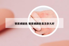 銀屑病褪色 銀屑病顏色變淡多久好