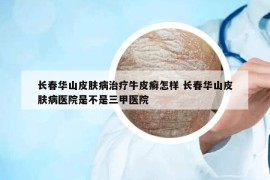 長(zhǎng)春華山皮膚病治療牛皮癬怎樣 長(zhǎng)春華山皮膚病醫(yī)院是不是三甲醫(yī)院
