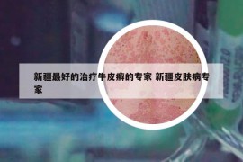 新疆最好的治療牛皮癬的專家 新疆皮膚病專家