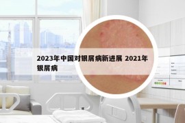 2023年中國對(duì)銀屑病新進(jìn)展 2021年銀屑病