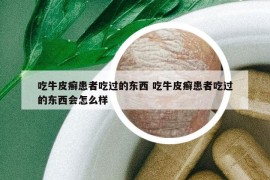 吃牛皮癬患者吃過的東西 吃牛皮癬患者吃過的東西會(huì)怎么樣