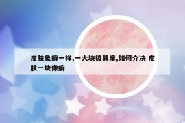 皮膚象癬一樣,一大塊極其庠,如何介決 皮膚一塊像癬