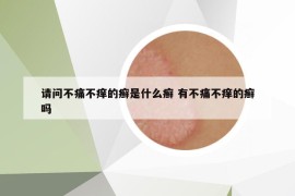 請(qǐng)問不痛不癢的癬是什么癬 有不痛不癢的癬嗎