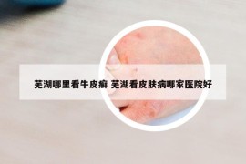 蕪湖哪里看牛皮癬 蕪湖看皮膚病哪家醫(yī)院好