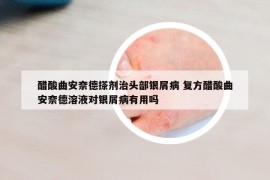 醋酸曲安奈德搽劑治頭部銀屑病 復(fù)方醋酸曲安奈德溶液對(duì)銀屑病有用嗎