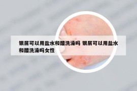 銀屑可以用鹽水和醋洗澡嗎 銀屑可以用鹽水和醋洗澡嗎女性