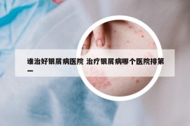 誰(shuí)治好銀屑病醫(yī)院 治療銀屑病哪個(gè)醫(yī)院排第一