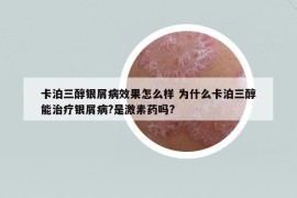 卡泊三醇銀屑病效果怎么樣 為什么卡泊三醇能治療銀屑病?是激素藥嗎?