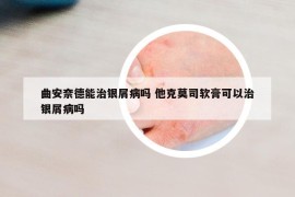 曲安奈德能治銀屑病嗎 他克莫司軟膏可以治銀屑病嗎