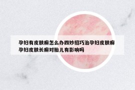 孕婦有皮膚癬怎么辦四妙招巧治孕婦皮膚癬 孕婦皮膚長(zhǎng)癬對(duì)胎兒有影響嗎