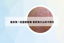 束狀發(fā)一定是銀屑病 束狀發(fā)什么樣子照片