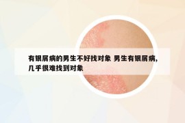 有銀屑病的男生不好找對象 男生有銀屑病,幾乎很難找到對象