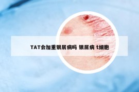 TAT會加重銀屑病嗎 銀屑病 t細(xì)胞