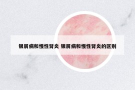 銀屑病和慢性腎炎 銀屑病和慢性腎炎的區(qū)別