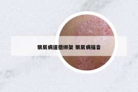 銀屑病道德綁架 銀屑病福音