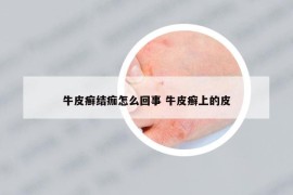 牛皮癬結(jié)痂怎么回事 牛皮癬上的皮