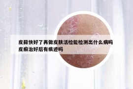 皮蘚快好了再做皮膚活檢能檢測出什么病嗎 皮癬治好后有痕跡嗎