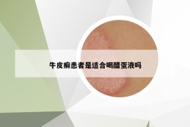 牛皮癬患者是適合喝醋蛋液嗎
