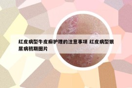 紅皮病型牛皮癬護(hù)理的注意事項(xiàng) 紅皮病型銀屑病初期圖片