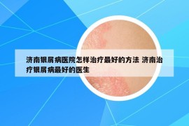 濟南銀屑病醫(yī)院怎樣治療最好的方法 濟南治療銀屑病最好的醫(yī)生