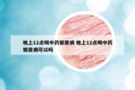 晚上12點(diǎn)喝中藥銀屑病 晚上12點(diǎn)喝中藥銀屑病可以嗎