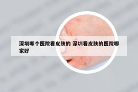 深圳哪個醫(yī)院看皮膚的 深圳看皮膚的醫(yī)院哪家好