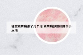 輕微銀屑病漲了幾個泡 銀屑病部位紅腫長小水泡
