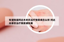 有誰知道阿達木單抗治療銀屑病怎么樣 阿達木單抗治療銀屑病效果