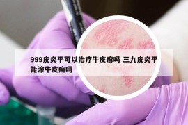 999皮炎平可以治療牛皮癬嗎 三九皮炎平能涂牛皮癬嗎