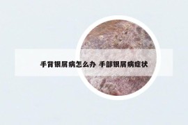 手背銀屑病怎么辦 手部銀屑病癥狀