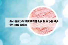 血小板減少對銀屑病有什么關(guān)系 血小板減少會引起皮膚病嗎