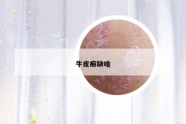 牛皮癬缺啥