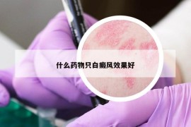 什么藥物只白癜風(fēng)效果好
