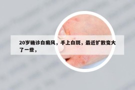 20歲確診白癜風(fēng)，手上白斑，最近擴散變大了一些，