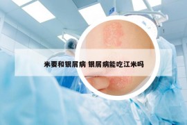 米要和銀屑病 銀屑病能吃江米嗎