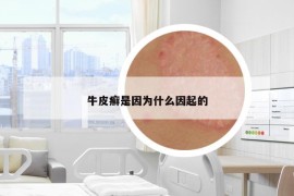 牛皮癬是因為什么因起的