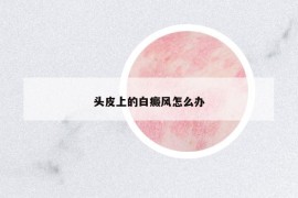 頭皮上的白癜風(fēng)怎么辦