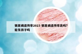 銀屑病遺傳率2023 銀屑病遺傳率高嗎?能生孩子嗎
