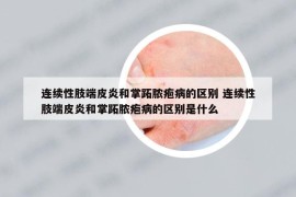 連續(xù)性肢端皮炎和掌跖膿皰病的區(qū)別 連續(xù)性肢端皮炎和掌跖膿皰病的區(qū)別是什么