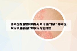 哪家醫(yī)院治銀屑病最好如何治療能好 哪家醫(yī)院治銀屑病最好如何治療能好些