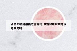 點(diǎn)滴型銀屑病能吃雪糕嗎 點(diǎn)滴型銀屑病可以吃牛肉嗎