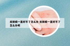 皮膚癬一直好不了怎么辦 皮膚癬一直好不了怎么辦呢