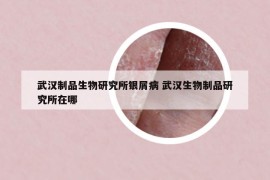 武漢制品生物研究所銀屑病 武漢生物制品研究所在哪