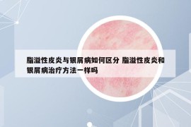 脂溢性皮炎與銀屑病如何區(qū)分 脂溢性皮炎和銀屑病治療方法一樣嗎
