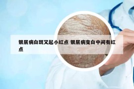 銀屑病白斑又起小紅點(diǎn) 銀屑病變白中間有紅點(diǎn)