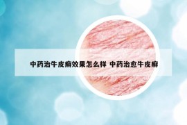 中藥治牛皮癬效果怎么樣 中藥治愈牛皮癬