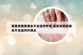 舅舅有銀屑病會不會遺傳外甥 舅舅有銀屑病會不會遺傳外甥女