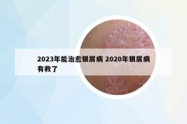 2023年能治愈銀屑病 2020年銀屑病有救了